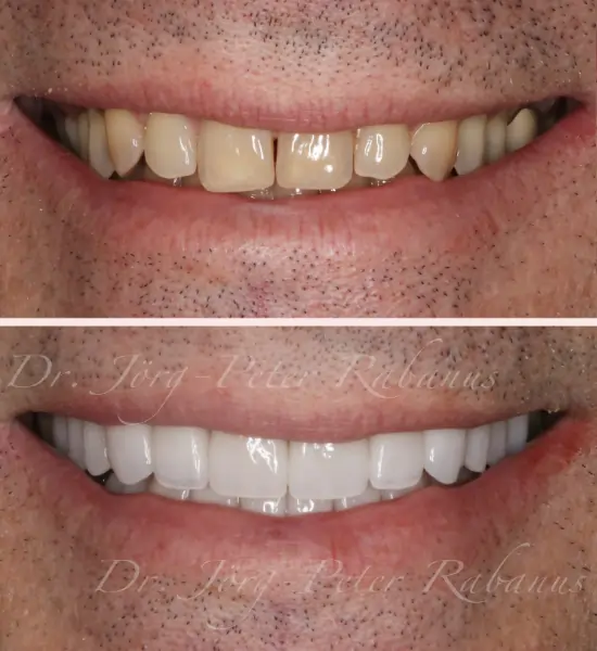 porcelain veneers placed by expert cosmetic dentist