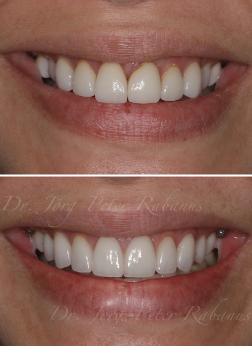 porcelain veneers san francisco before and after