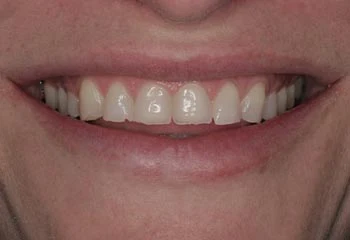 dental porcelain crowns for severely worn teeth