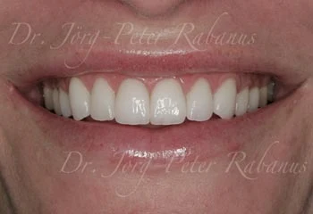 best porcelain crowns for smile design