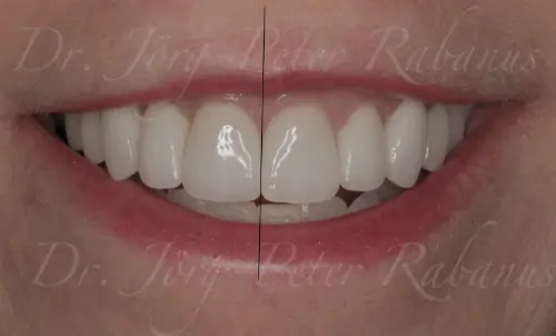 canted teeth veneers san francisco