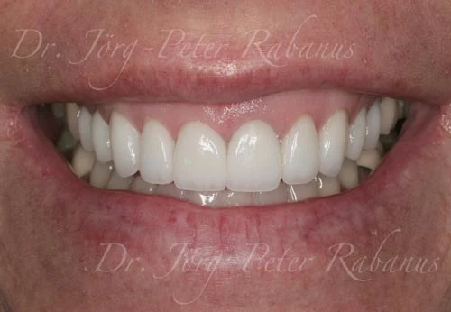 top porcelain veneers san francisco