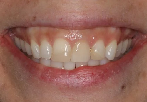 before natural porcelain veneers