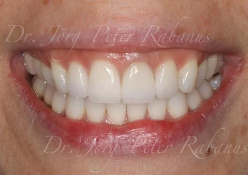 best porcelain veneers look natural