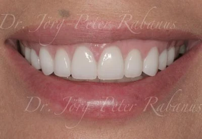 small teeth gummy smile after porcelain veneer placement