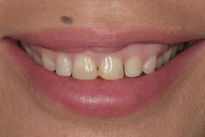 small teeth gummy smile before veneer placement