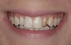 san francisco teeth whitening