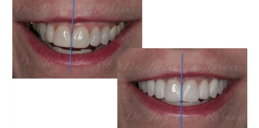 porcelain veneers to correct dental midline